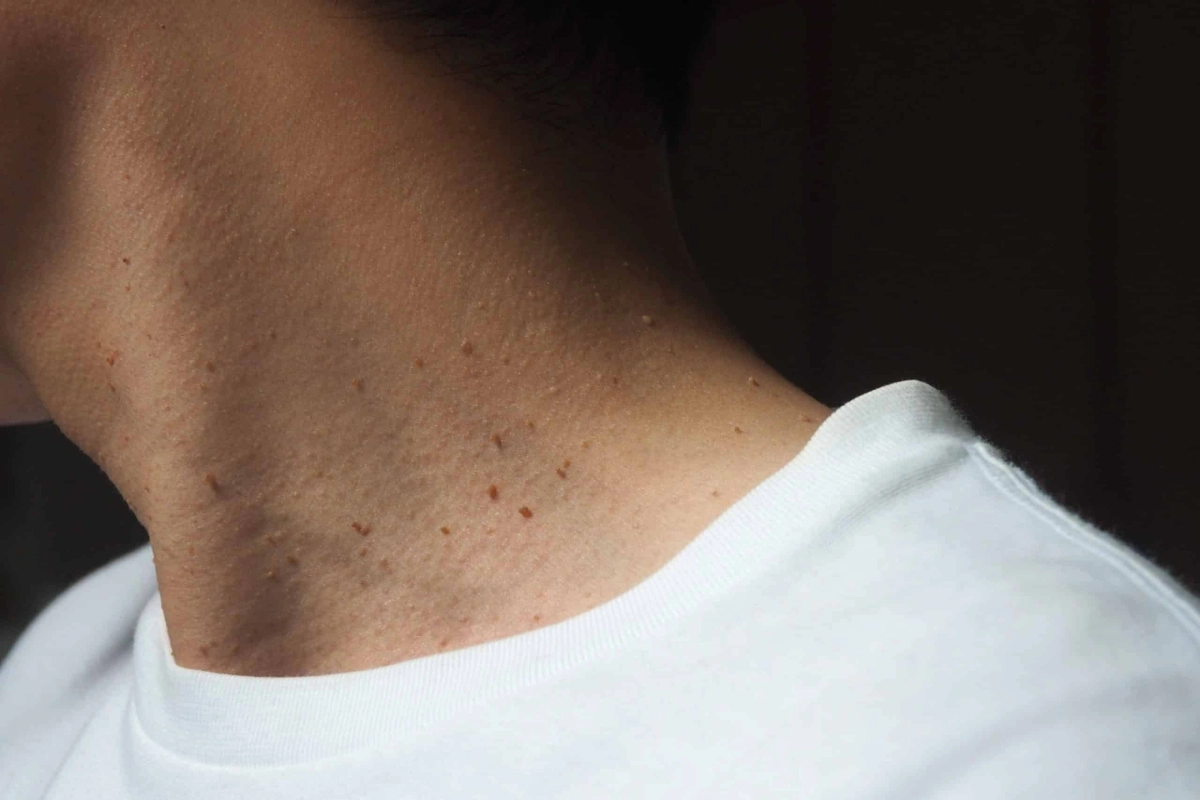 Say Goodbye To Skin Tags And More With Lamprobe!