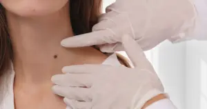 Dermatologist performing Lamprobe treatment in Yuma, AZ, to safely remove skin imperfections