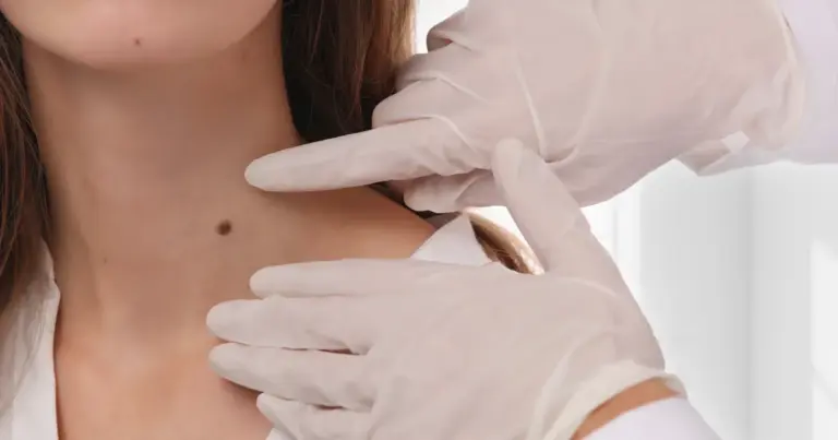Dermatologist performing Lamprobe treatment in Yuma, AZ, to safely remove skin imperfections