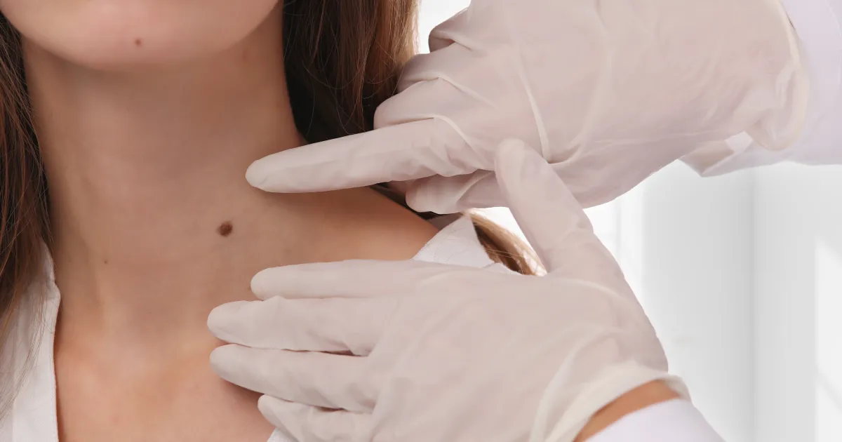 Dermatologist performing Lamprobe treatment in Yuma, AZ, to safely remove skin imperfections