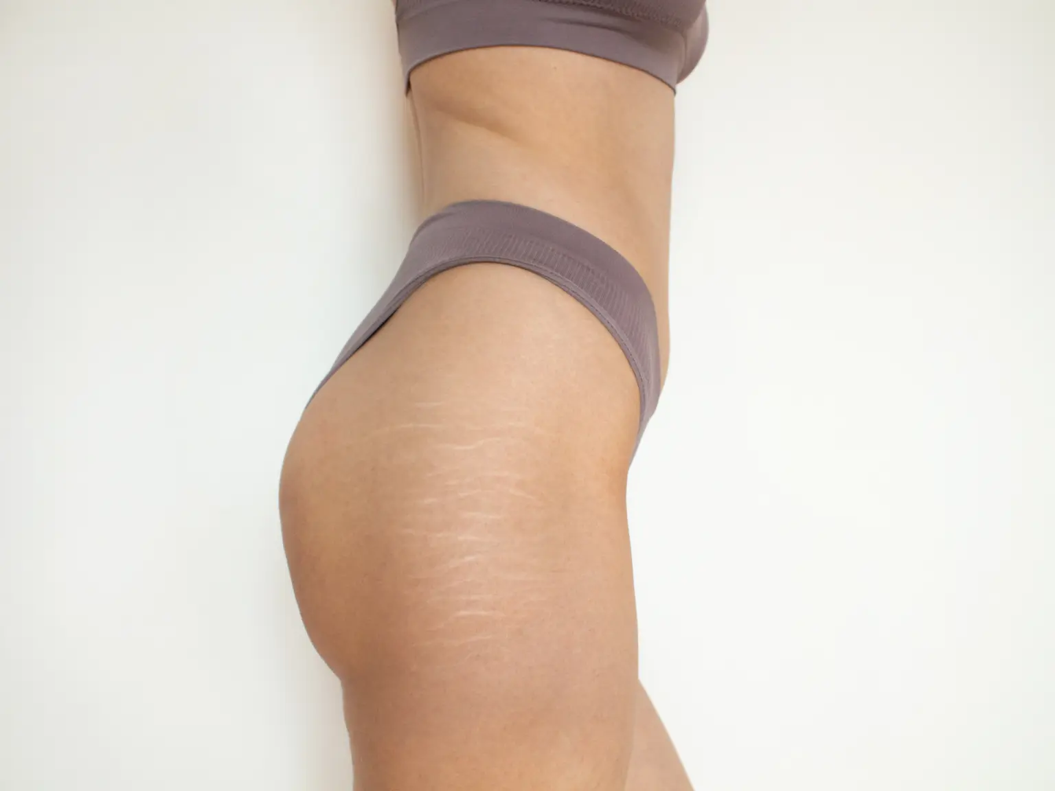 Woman showing stretch marks on thigh, explaining causes of stretch marks and scars at Amara Rejuve Medical Spa in Yuma, AZ