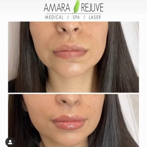 Before & After Beauty Treatment Image | Yuma, Az | Amara Rejuve