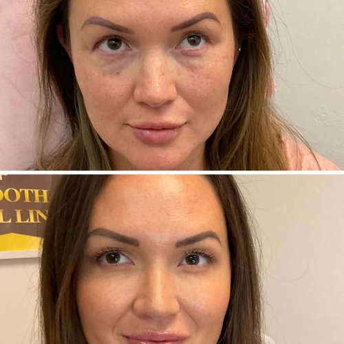 Cosmetic Treatments before & After image | Yuma, Az | Amara Rejuve