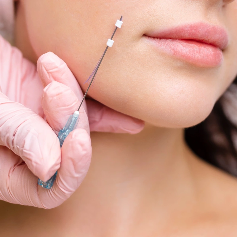 Patient receiving a PDO thread lift treatment for facial skin tightening in Yuma, AZ | Amara Rejuve Medical Spa & Laser